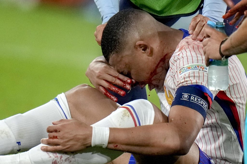 Les dirigeants de l'équipe de France transpirent suite à la blessure au visage de Kylian Mbappé