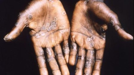 L'OMS va réunir des experts sur le virus MPOX alors que les cas augmentent en Afrique de l'Est